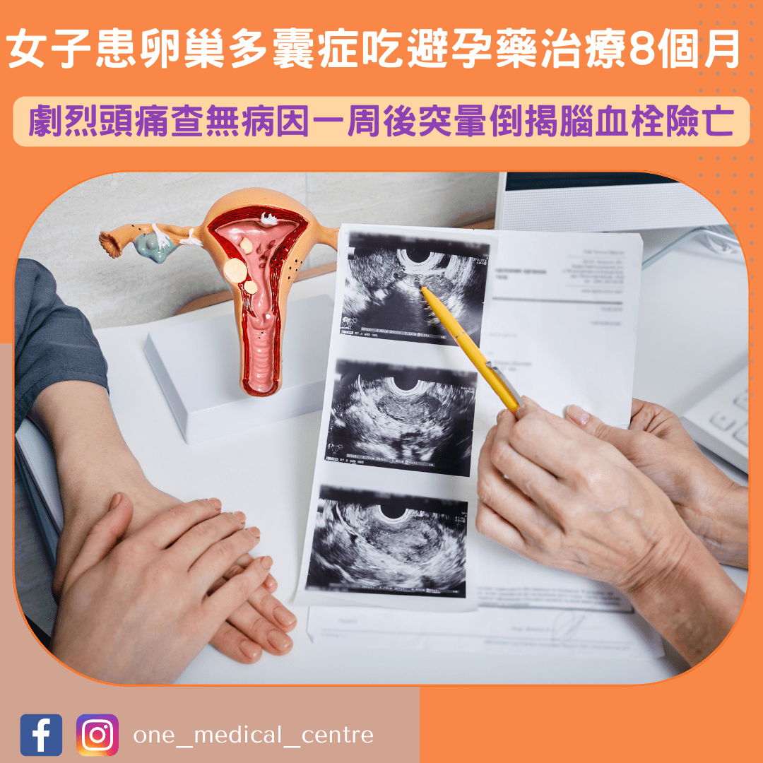 【女子患卵巢多囊症吃避孕藥治療8個月　劇烈頭痛查無病因一周後突暈倒揭腦血栓險亡💊】